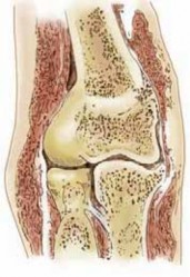 Precision Arthroscopy for Chondral Injuries & OCD: Direct Lateral Portal