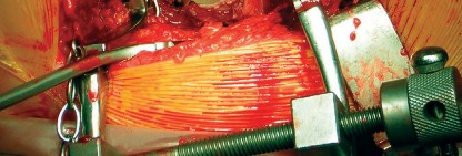 صورة توضيحية للعلاج الطبيعي لآلام الورك