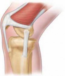 Fix Patellar Instability: Realignment of the Medial Ligament