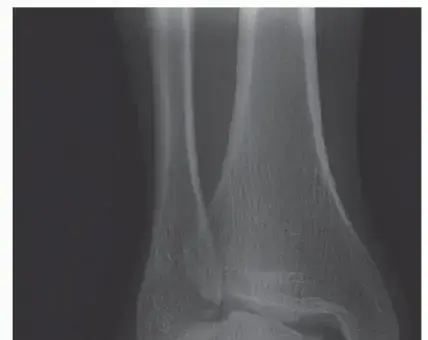 جراحة ترميم الرباط الدالي في الكاحل: دليلك الشامل لاستعادة الثبات والحركة مع الأستاذ الدكتور محمد هطيف