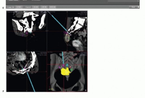 صورة طبية: جراحة أورام العجز: الحفاظ على وظائف الأمعاء والمثانة مع الأستاذ الدكتور محمد هطيف في صنعاء