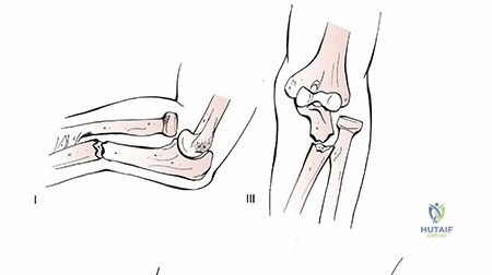 Illustration of radius and ulna - Dr. Mohammed Hutaif