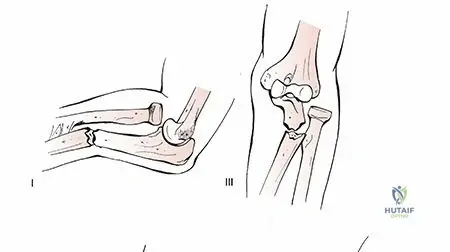 Mastering Radius & Ulna Shaft Fractures: Key Concepts Explained
