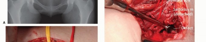 توضيح طبي: جراحة نقائل الحوض: حل شامل لآلام العظام واستعادة الحركة مع الأستاذ الدكتور محمد هطيف