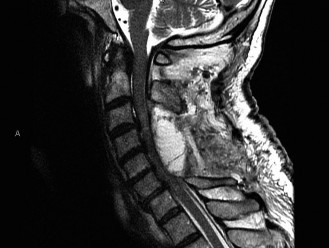 Illustration 24 for Adjacent Segment Degeneration: Your Next Spine Case Solved