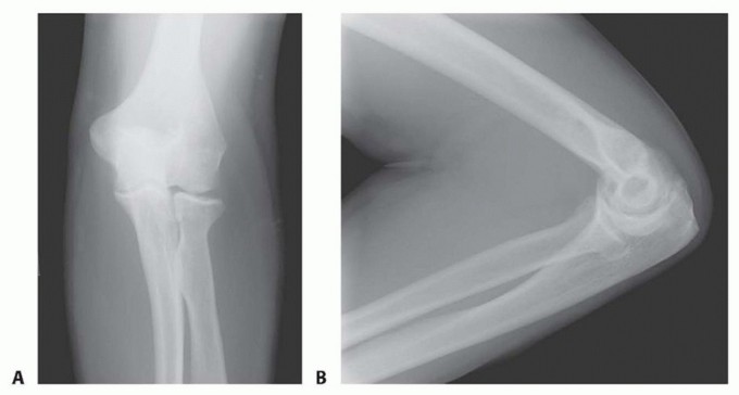 Illustration of columnar release for extracapsular - Dr. Mohammed Hutaif