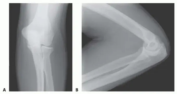 تيبس الكوع: دليل شامل للمرضى لاستعادة حركة ذراعك مع الأستاذ الدكتور محمد هطيف