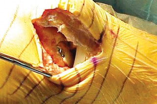 Illustration 28 for Unicompartmental Knee Arthroplasty: Master decisions with this b c figure guide.