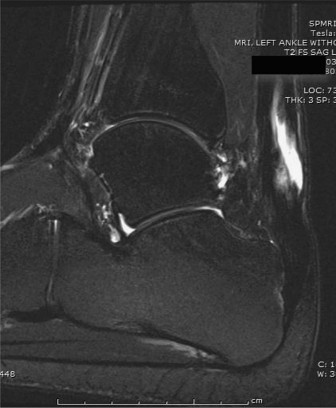 Solving Chronic Achilles Rupture: FHL Transfer & Knot of Henry