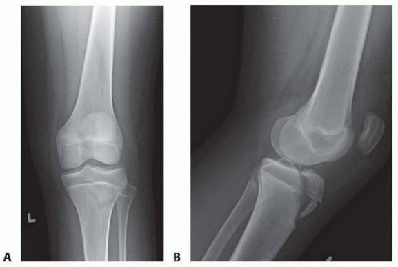 Adolescent Tibial Tuberosity Fractures: What Parents Need to Know