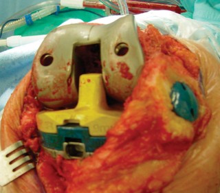 Illustration 32 for Revision of Failed UKA: Your Guide to Successful Treatment