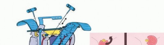 Illustration 27 for Total En Bloc Spondylectomy: Complete Resection for Spinal Tumors