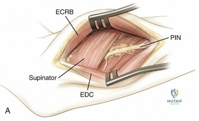 Miller MD et al: Essential Surgical Approaches to the Upper Extremity