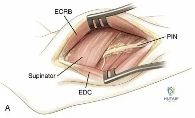 Illustration of miller md et al - Dr. Mohammed Hutaif