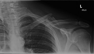 Illustration of middlethird clavicle fractures - Dr. Mohammed Hutaif