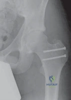 Dynamic Intraoperative Impingement Testing
