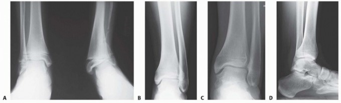 Distal Tibial Osteotomy: Fixing Varus & Valgus Ankle Alignment
