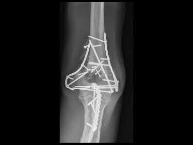 Identify the Critical Injury Shown in Figure: Orthopedic Trauma MCQ