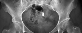 Beyond Arthroscopy: Surgical Hip Dislocation for Complex Instability