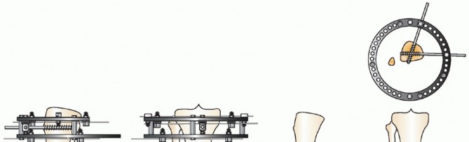 Illustration 14 for Beyond Amputation: Circular Fixation for Infection of the Talus