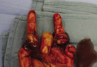 Hand Injury Case 45: What Is the Typical Rate of Nerve Regeneration?