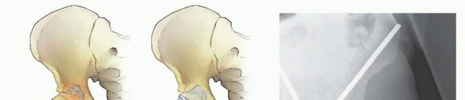 Illustration of arthroplasty for malignant - Dr. Mohammed Hutaif