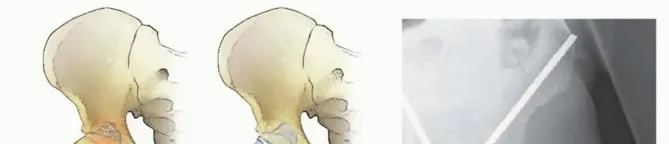 صورة توضيحية لـ استعادة الحركة بعد سرطان الورك: جراحة استبدال مفصل الورك الكلي للآفات الخبيثة مع الأستاذ الدكتور محمد هطيف في صنعاء