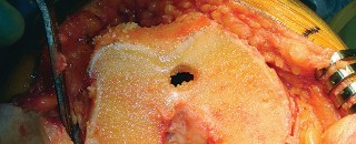 Illustration 20 for Mastering TKA: Essential Methods of Rotational Alignment