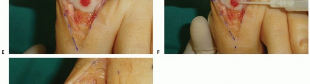 Illustration 21 for Mastering Extensive Plantar Release for Hallux Rigidus