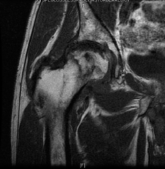 Illustration 2 for Avascular Necrosis: Navigating Complex Reconstruction Cases