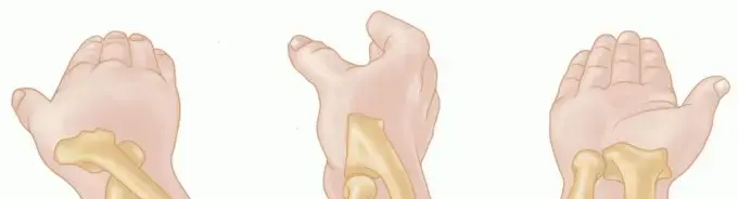 صورة توضيحية لـ كسور رأس وعنق الكعبرة: دليل شامل للعلاج والتعافي مع الأستاذ الدكتور محمد هطيف