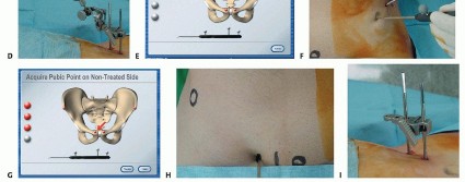 صورة طبية: ترميم مفصل الورك: الحل الأمثل للحفاظ على عظم رأس الفخذ في صنعاء مع الدكتور محمد هطيف