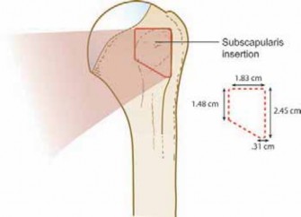Arthroscopic Subscapularis Repair: The lo iky brady Method for Stability