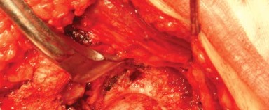 Illustration 16 for Posterolateral Surgical Approaches: Achieve Optimal Hip Replacement