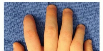 Preaxial and Postaxial Polydactyly