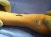 صورة توضيحية لـ إصابات العظام والمفاصل الكبرى: دليل شامل لكسور الفخذ والساق وخلع الكتف في اليمن