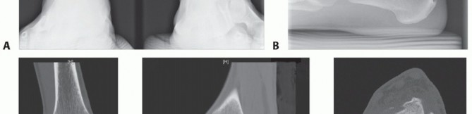 Illustration 23 for Unlock Healing: Medial Malleolar Osteotomy for Talus OLT Allografts