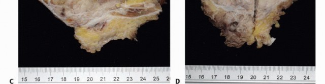 صورة طبية: جراحة أورام العجز: الحفاظ على وظائف الأمعاء والمثانة مع الأستاذ الدكتور محمد هطيف في صنعاء
