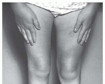 Williams Rod: Achieve Stability for Pseudarthrosis within the Tibia