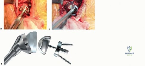 Congenital Anomalies of the Hand: Principles, Classification, and Operative Management