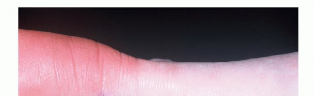 Illustration of open management of achilles - Dr. Mohammed Hutaif