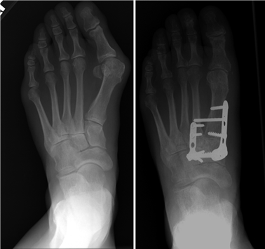 Illustration 44 for First Metatarsal Surgery: Expert Solutions for Foot & Ankle Pain