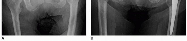 صورة طبية: تثبيت مفصل الورك بدون أسمنت: دليل شامل لمرضى استبدال الورك مع الأستاذ الدكتور محمد هطيف
