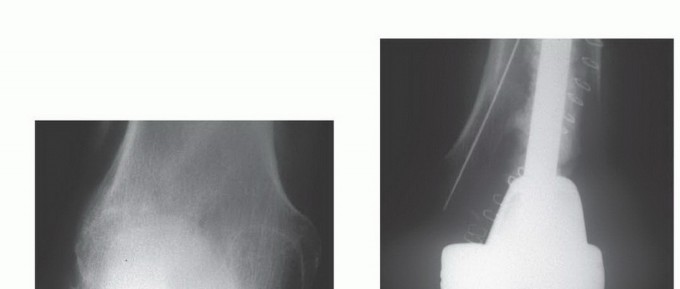 صورة طبية: تجنب الجراحة الكبرى: علاج أورام العظام بالنيتروجين السائل بتقنية الصب المباشر