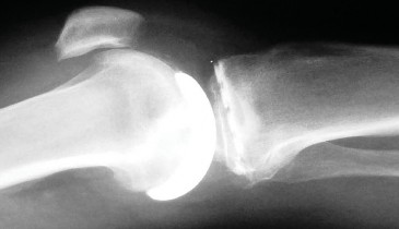 Illustration 38 for Knee Arthroplasty: Avoiding Pitfalls & Benefiting from UKA