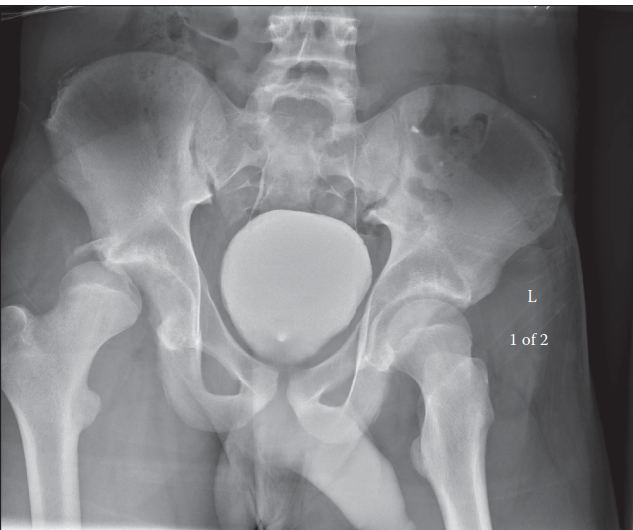 Posterior Hip Dislocation: Comprehensive Orthopedic Diagnosis & Management