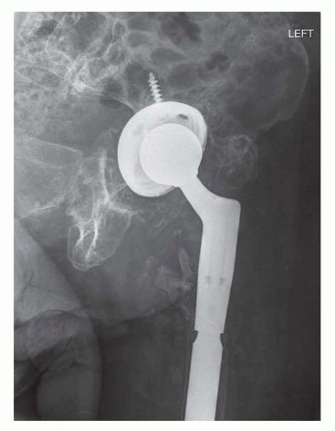 Illustration 3 for Pelvic Discontinuity: Understanding Superior and Inferior Separation