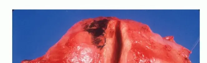 صورة توضيحية لـ خزعة أورام الجهاز العضلي الهيكلي الدقيقة: مفتاح التشخيص السليم والعلاج الفعال في صنعاء مع الأستاذ الدكتور محمد هطيف