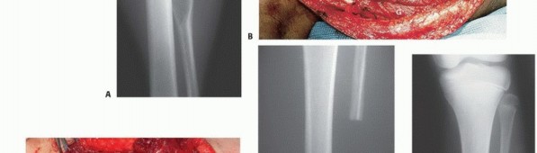 صورة طبية: استئصال أورام الشظية: دليل شامل للعلاج الحديث والحفاظ على الأطراف مع الأستاذ الدكتور محمد هطيف