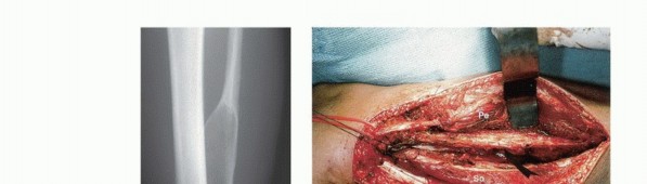 صورة طبية: استئصال أورام الشظية: دليل شامل للعلاج الحديث والحفاظ على الأطراف مع الأستاذ الدكتور محمد هطيف